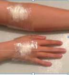 A picture of an arm and a hand with the cream under the clear covering