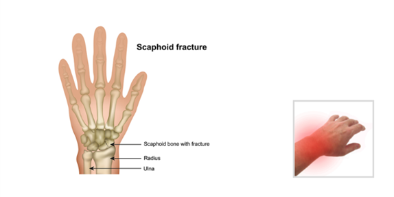 scaphoid fracture.png