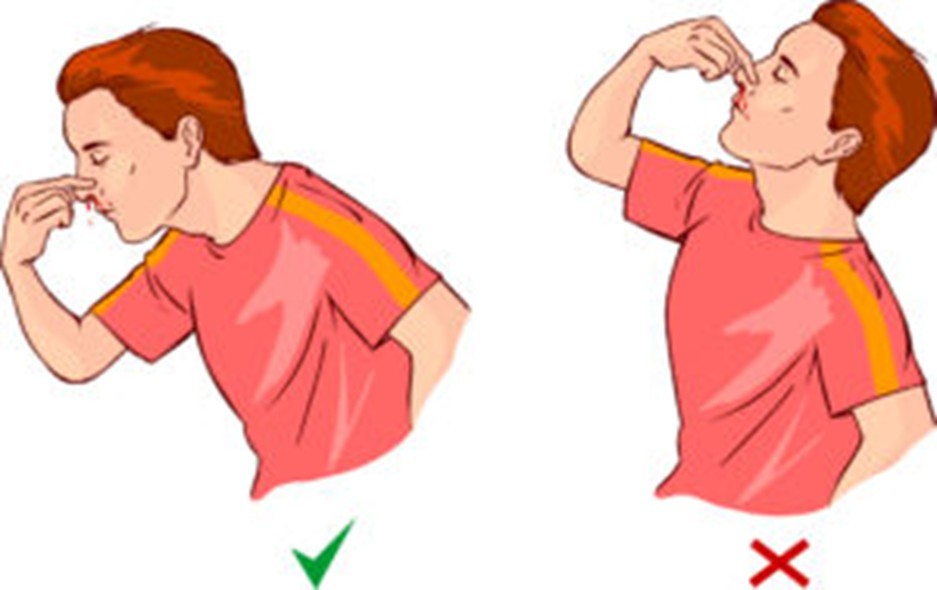 A photo to show how to hold your nose and hoe not to hold your nose when having a nose bleed.