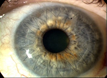 zig-zag stitches in the first few months after keratoplasty.jpg