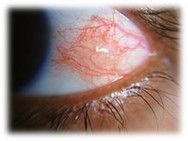 episcleritis eye with a patch of red vessels.jpg