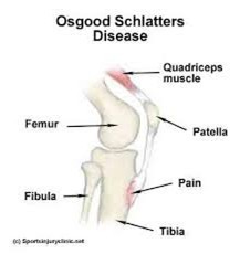 osgood schlatters 1.jpg