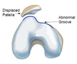 abnormal groove.png