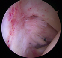 frozen shoulder.png