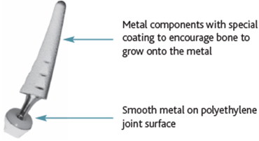 thumb and joint replacement parts.png