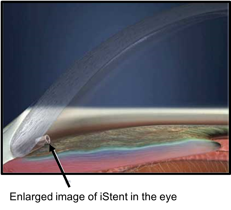 Enlarged image of iStent in the eye.png