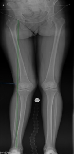 knock knee on XR.jpg