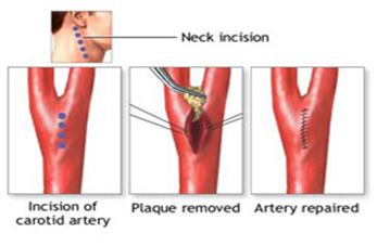 Carotid artery procedure.png
