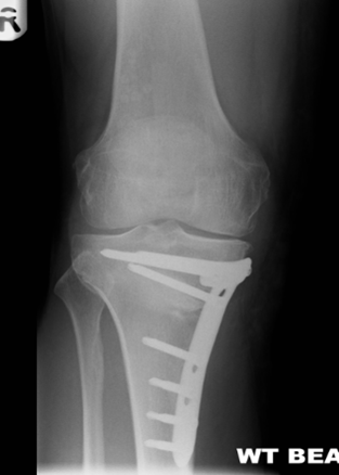xray showing plate in position.png