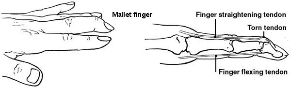 mallet injury.jpg
