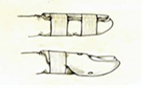 Mallet finger 3.png