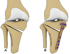 high tibial osteotomy.png
