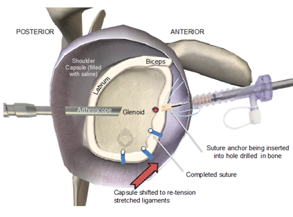 surgical repair of labrum.png
