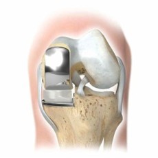 unicompartmental knee replacement.jpg