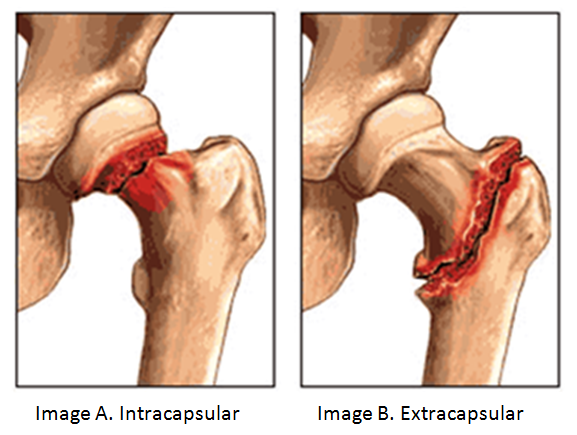 Hip Fracture.png