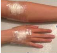 child-blood-test-wrapped-creams.png