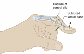 central slip injury.png
