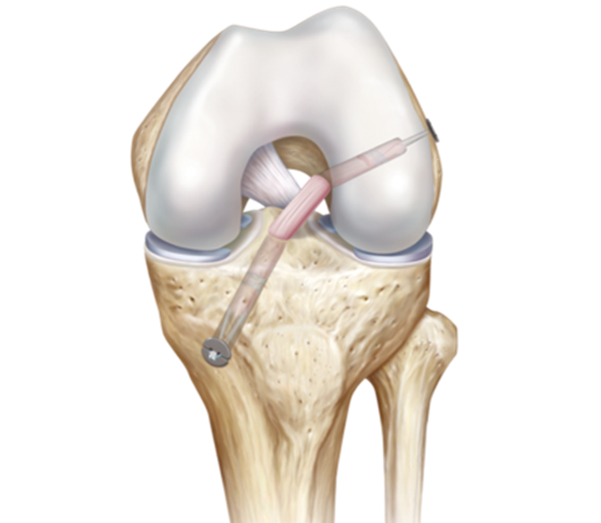 knee following ACLR.png