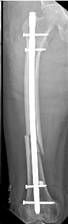 Intramedullary Nail.png