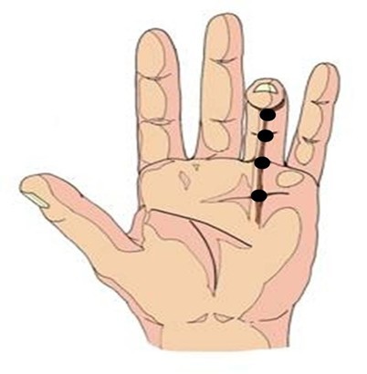 Needle aponeurotomy.jpg
