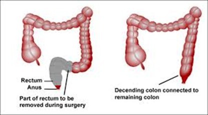 Ileostomy.jpg