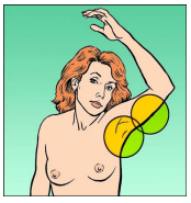 Melanoma_4.png