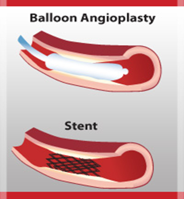Angioplasty stent.png