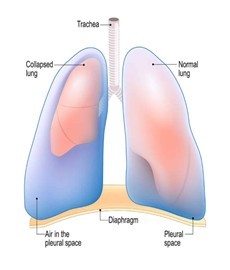 chest drain 1.jpg