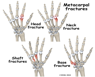 metacarpal hand fracture.png