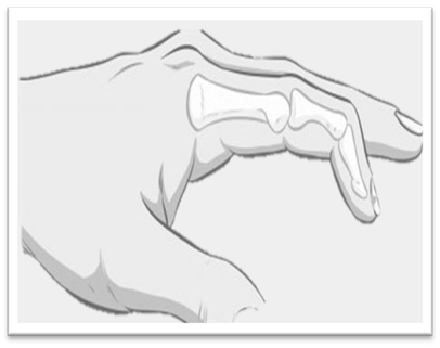 Mallet finger.png