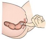 Suppository administer.jpg