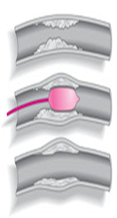 Balloon angioplasty.png
