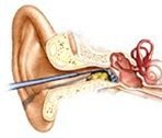microsuction 1.jpg