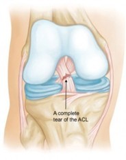 ACL rupture.jpg