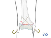 K wire 1.png