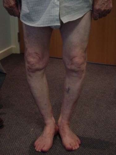bow legs XR.jpg
