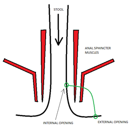 Anal fistula 1.png