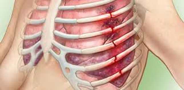Illustration of a torso with a view of insides- several ribs broken in the same place with the lungs underneath bruised and inflamed.