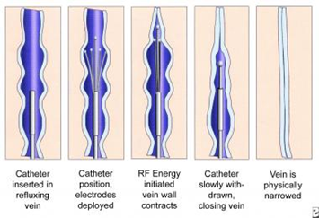 Radiofrequency ablation.png