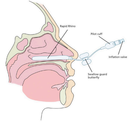 nasal packing1.png