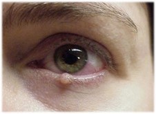 lamp and bump on eyelid (3).jpg