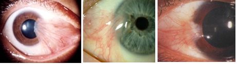 examples of pterygium.png