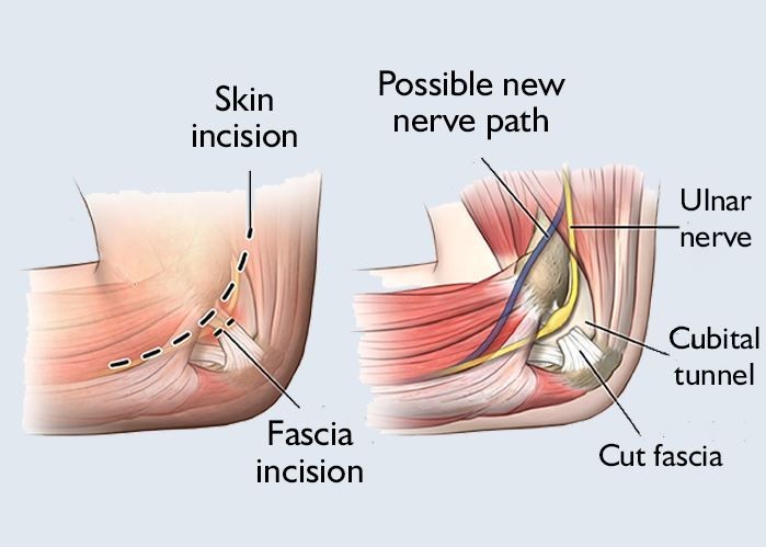 cubital tunnel procedure.jpg