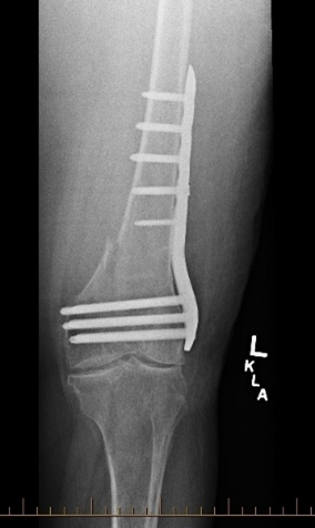 Open Reduction and Internal Fixation (ORIF).png