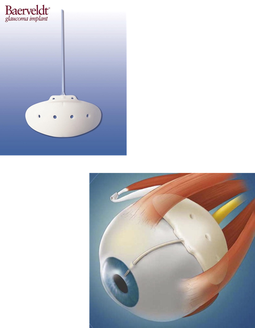 Image of Baerveldt implant.png