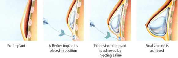 Breast implant.png