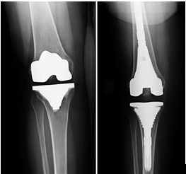 Revision total Knee.png