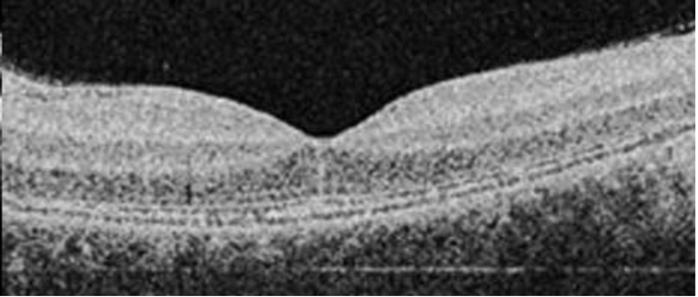 Scan of a normal macular.jpg