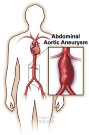 Abdominal Aortic Aneurism.jpg