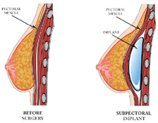 Breast implant surgery.png